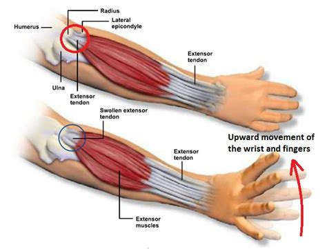 Tennis Elbow - What is it? - Fox Physiotherapy