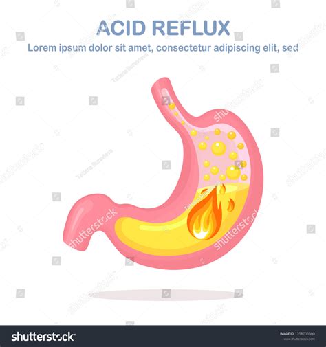 Human Stomach Gastroesophageal Reflux Disease Gerd Stock Vector