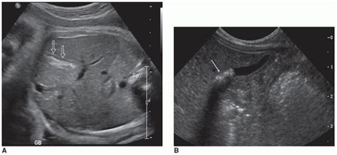 The Gallbladder And Biliary System Radiology Key