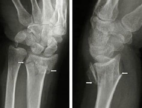 Colles’ Fracture - Pictures, Treatment, Healing Time, Surgery, Symptoms ...