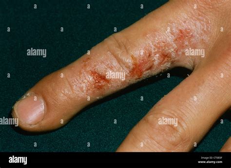 Dishidrosis Fotografía De Stock Alamy