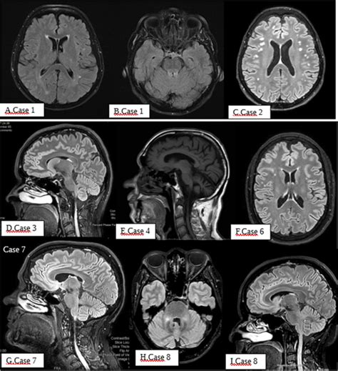 Neuroimaging Abnormalities In Patients Carrying The Intermediate