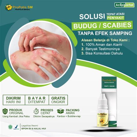 Jual Obat Budug Scabies Kudis Eksim Gatal Ruam Kulit Bintik Bintik Luka