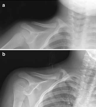 Shoulder Dystocia Xray