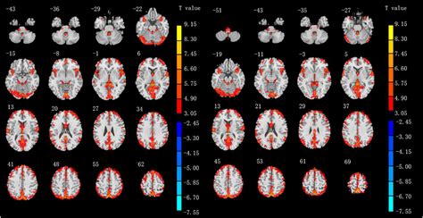 Frontiers Altered Spontaneous Brain Activity Patterns And Functional