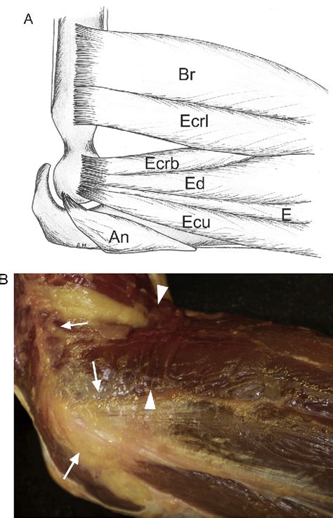 Figure 13 From Ultrasound Of The Elbow With Emphasis On Detailed