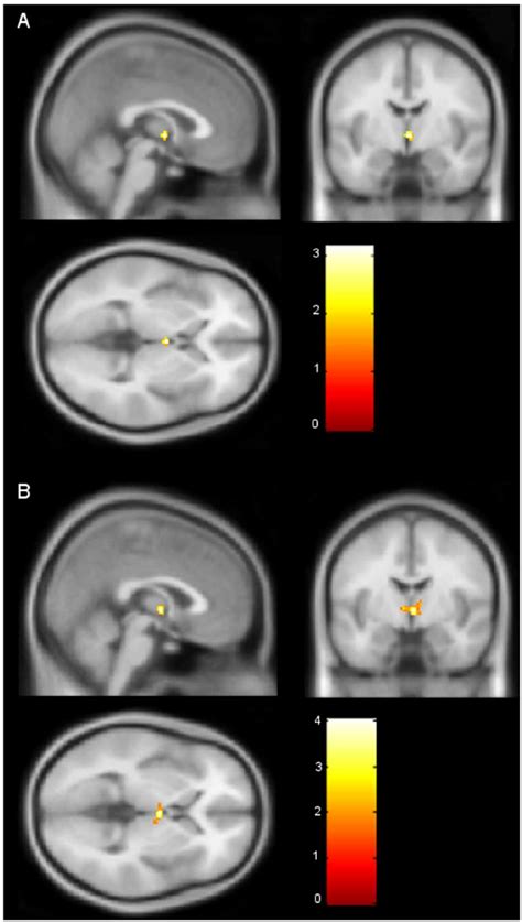 Sex Differences In Hypothalamus Activation A Hypothalamus Activation Download Scientific