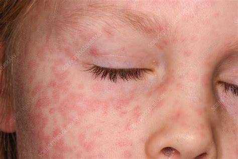 Erythema Multiforme On A Girls Face Stock Image C0585189