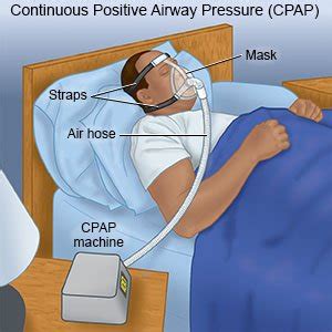 Cpap Blog Knak Jp