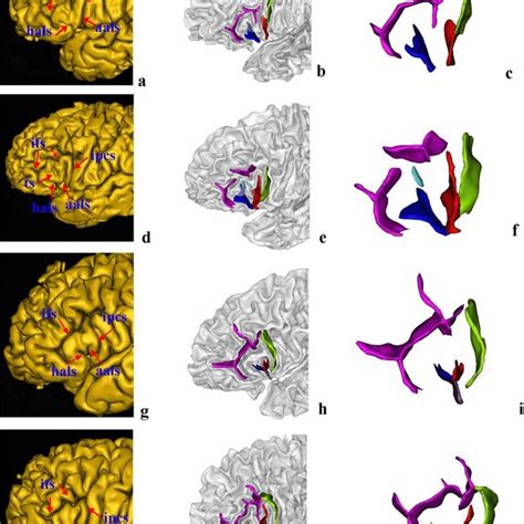 Pdf Morphological And Hemispheric And Sex Differences Of The Anterior Ascending Ramus And The