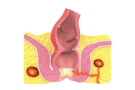 What Is An Anal Polyp Why Does It Occur And How Is It Treated
