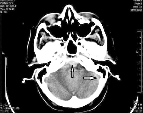 Ct Scan Of Brain With Arrows Showing Subarachnoid Hemorrhage In Basal