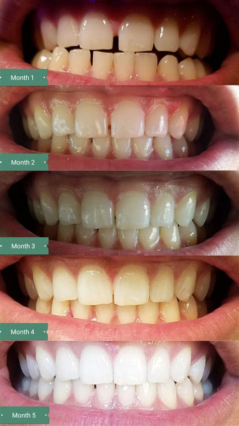 How To Use Smile Direct Club Whitening Tip Or Tech