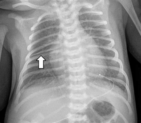 Respiratory Distress In Neonates Radiologic Clinics