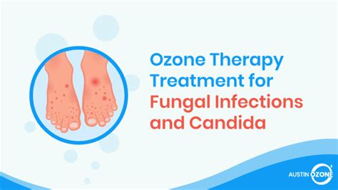 Fungal Infections Ozone Therapy For Fungal Infections