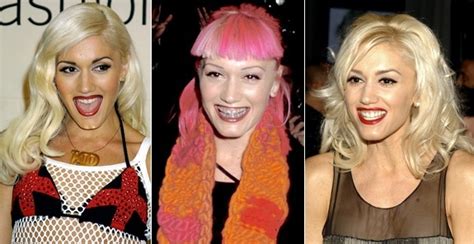 Gwen Stefani Rocked Her Braces As Fashion Ill Grills Celebrity Teeth Makeovers From Ny Daily