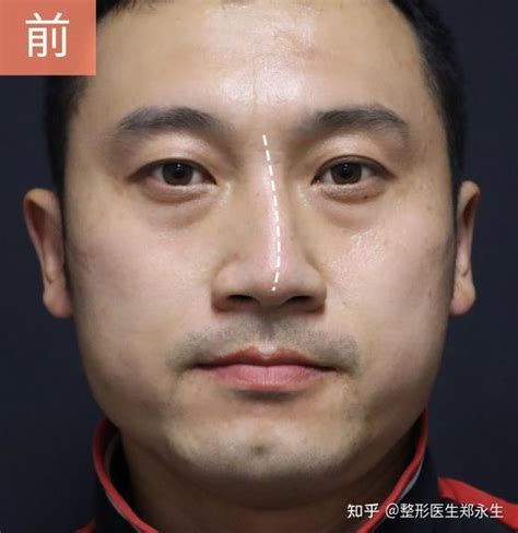 35岁男子鼻中隔偏曲呼吸不畅，矫正1年后，呼吸顺畅无后遗症 知乎