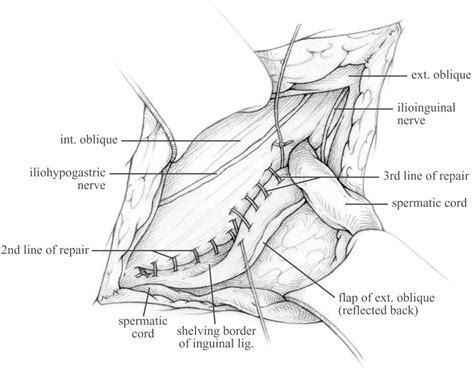 Figure 8 From The Shouldice Repair For Groin Hernias Semantic Scholar