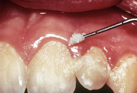 Dental Plaque And Gum Disease By Science Photo Library