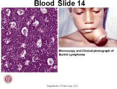 Lymphoma: Burkitt''s Lymphoma Symptoms