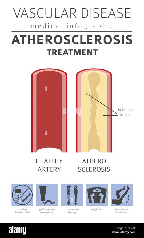 Las Enfermedades Vasculares Los S Ntomas De La Aterosclerosis El