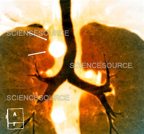 Aortic aneurysm, X-ray | Stock Image - Science Source Images