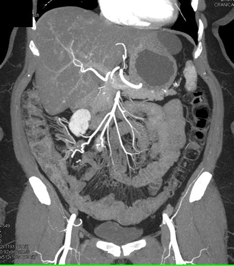 Carcinoid Tumor Root Of Mesentery With Desmoplastic Reaction Small