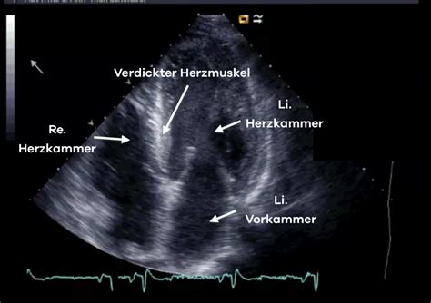 Welche Bedeutung Hat Der Herzultraschall Bei Bluthochdruck