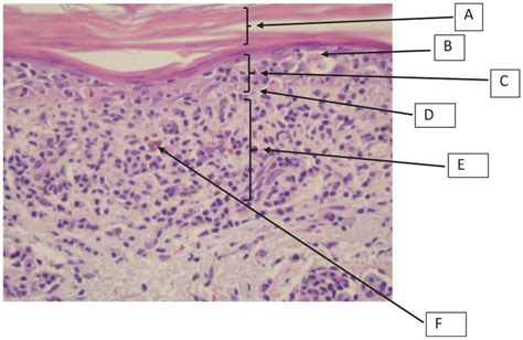 Skin Biopsy Histopathology Revealing Lichen Planus Type Drug