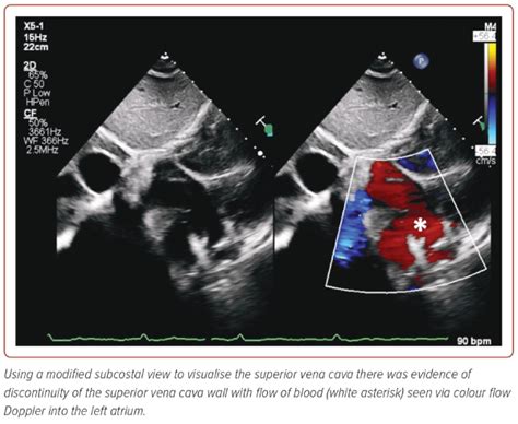 Figure 4 2d Transthoracic Echocardiogram Using A Subcostal View