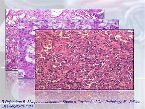Tumors Of Salivary Glands Pptx