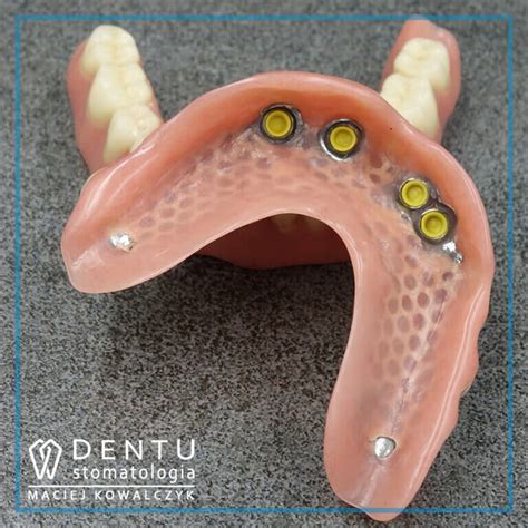 Protezy Na Implantach Gabinet Stomatologiczny Tczew DENTU