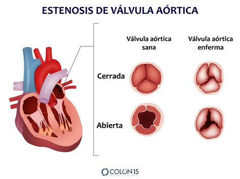 Estenosis y enfermedad de Válvula Aórtica Cardiología Cardiopatías