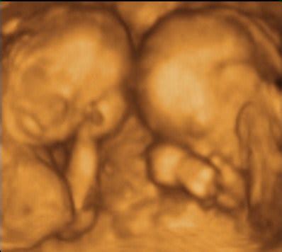 Services Pricing 3D Ultrasound And 4D HD Ultrasound Glastonbury