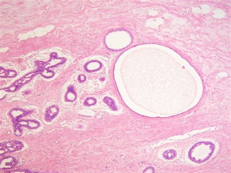 Mastopathia fibrosa et cystica (preparát) – WikiSkripta
