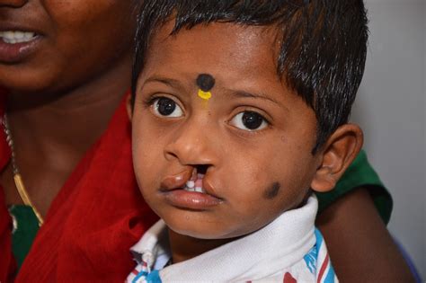 Mulbhagal Facial Deformity Screening Camp | Flickr