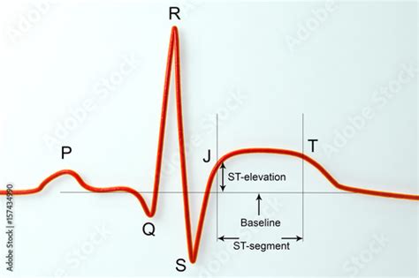 "ECG in myocardial infarction. 3D illustration showing ST elevation, labeled image" Stock photo ...