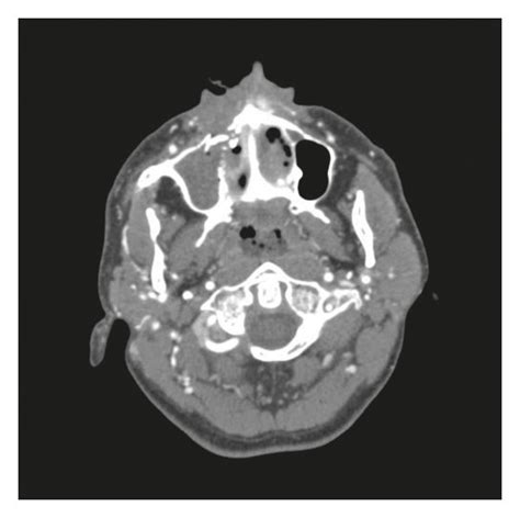 Preoperative Axial Computed Tomography Showing A Right Anterior