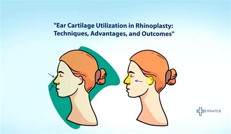 Ear Cartilage Graft Rhinoplasty | Procedure & Cost | Ermateb