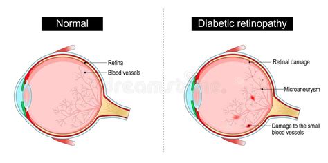 Diabetic Retinopathy Stock Illustrations 399 Diabetic Retinopathy Stock Illustrations Vectors