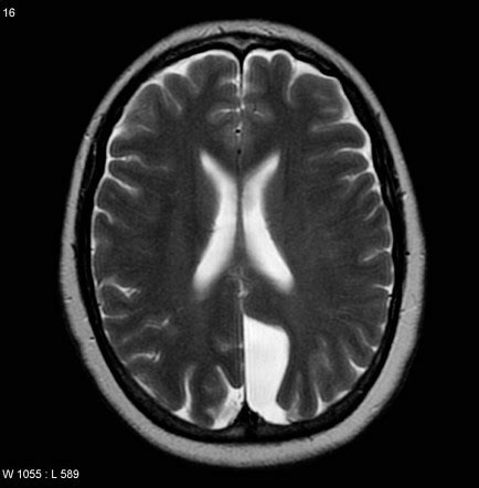 Arachnoid cyst | Radiology Reference Article | Radiopaedia.org