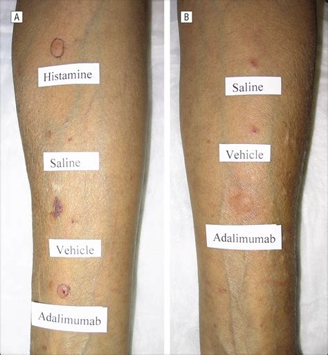 Immediate Type I Hypersensitivity Response Implicated In Worsening