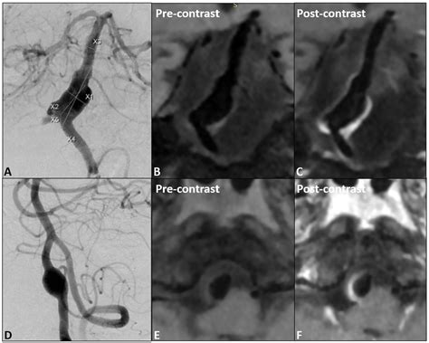 Frontiers Wall Enhancement Predictive Of Abnormal Hemodynamics And