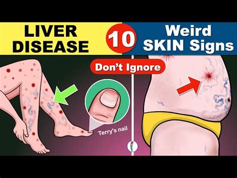 Liver Cirrhosis Symptoms Skin