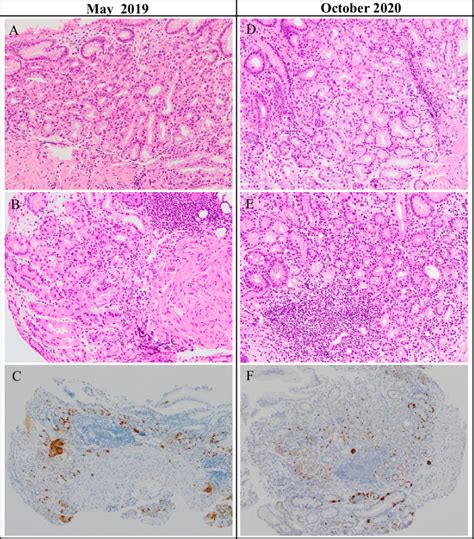 Figure6.Histopathological findings of Case 2 in May 2019 (A-C) and ...