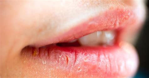 Cracked Lips Symptoms Causes Treatments