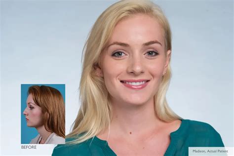 Natural Looking Nose Job West Los Angeles Rawnsley Plastic Surgery