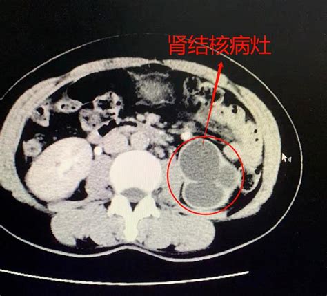 不一樣的「尿路感染」讓她損失了一個腎 每日頭條