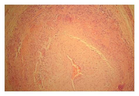 Temporal Artery Biopsy Showing Arteritis Download Scientific Diagram