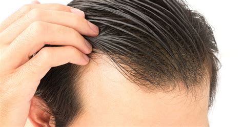 Can Anemia Impact My Hair Loss Rhrli